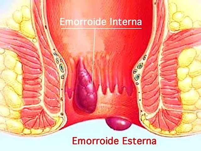 emorroidi esterne