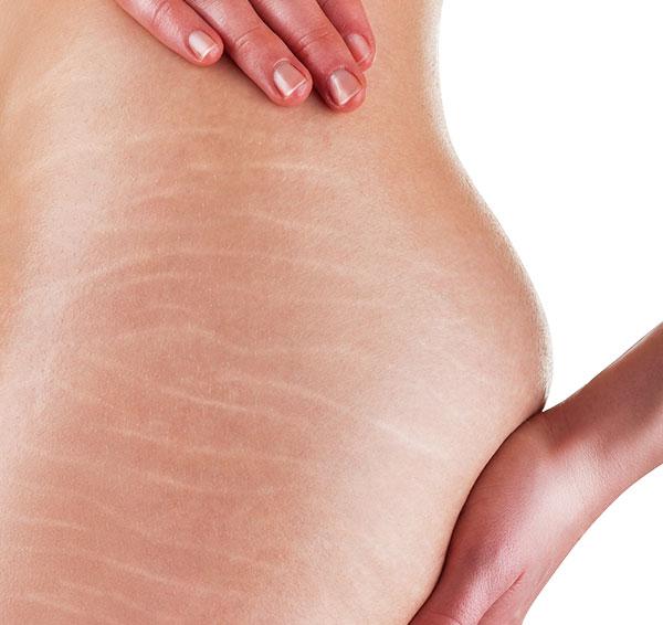 Come curare le smagliature in vista della bella stagione